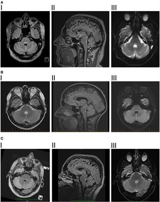 Frontiers | Isolated Horizontal Gaze Palsy: Observations And Explanations